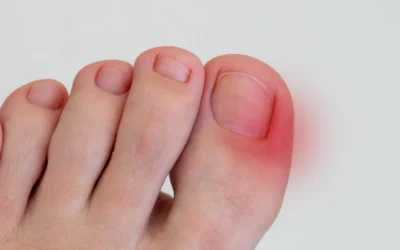 Uñas encarnadas: por qué aparecen y cómo prevenirlas